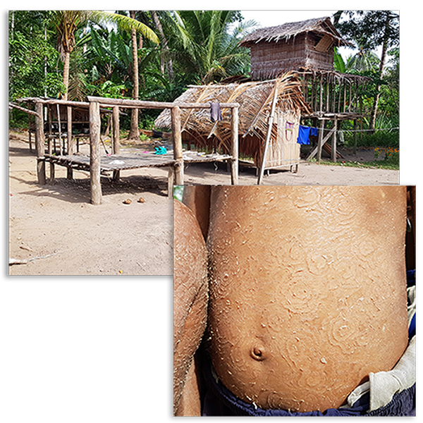Hut in Papau New Guinea Village and Skin Issue on Stomach Skin